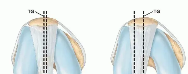 صورة توضيحية لـ نقل الحدبة الظنبوبية: دليل شامل للمرضى لاستعادة استقرار الركبة والتخلص من الألم