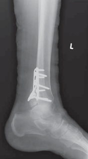 Illustration 34 for Optimal Fixation of the Ankle: Open Reduction & Internal Fixation