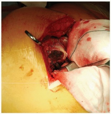 Illustration 4 for Why Polished Tapered Cemented Stems Excel in Hip Replacement