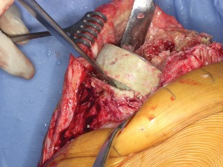 Illustration 43 for PROSTALAC Articulating Spacer: Treat Infected Knees, Regain Mobility