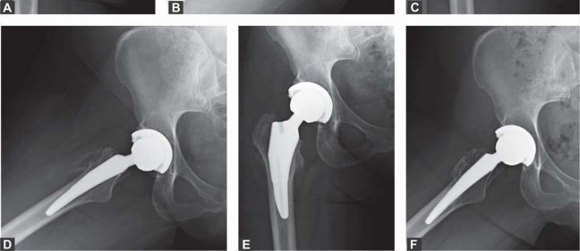 Illustration 67 for Unlock better THA: The technique of short stem for less invasiveness
