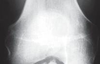 Unicompartmental Knee Arthroplasty: Master decisions with this b c figure guide.