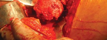 Illustration 18 for The Silent Hip: Achieving a Truly Silent, Pain-Free Joint