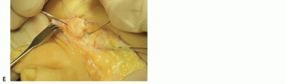 Illustration 29 for Plantar Plate Repair: End Lesser Toe Pain & Instability