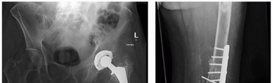 Illustration 17 for Mastering Revision THA: Strategies for Adverse Local Tissue Challenges