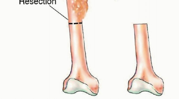Illustration 13 for Free Vascularized Fibular Grafts: Solving Complex Bone Defects