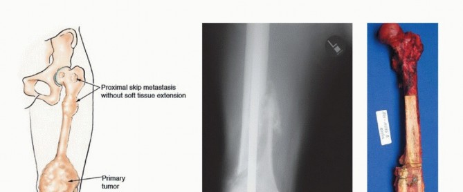 Illustration of hip joint capsule - Dr. Mohammed Hutaif