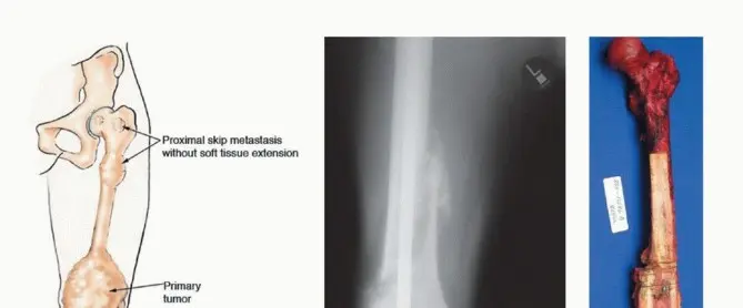 استئصال مفصل الورك: دليل شامل للمرضى مع الأستاذ الدكتور محمد هطيف