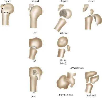 صورة توضيحية لـ كسور عظم العضد القريب: دليل شامل للمرضى مع الأستاذ الدكتور محمد هطيف