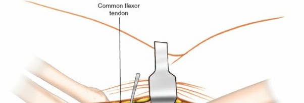 Illustration 46 for Mastering Elbow Approaches: Applied Surgical Anatomy for Precision