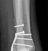 Illustration 9 for Partial Articular Fractureplate Fixation: Restore Anatomy