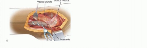 Illustration 4 for Well-Fixed THA Revisions: Precision in the Portion of the Osteotomy