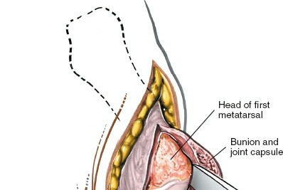Illustration 197 for Optimized Approaches to the Dorsum of the Foot & Ankle
