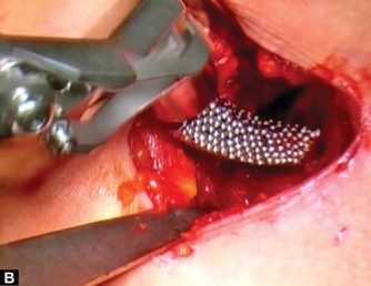 Illustration 19 for Mastering the Anterolateral Approach in Minimally Invasive Hip Replacement