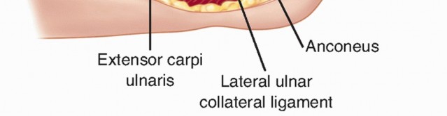 Illustration 29 for Radial Head Arthroplasty: Restoring Elbow Function & Stability