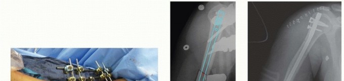 Lateral to Medial Nailing: Optimizing Humeral Fracture Fixation
