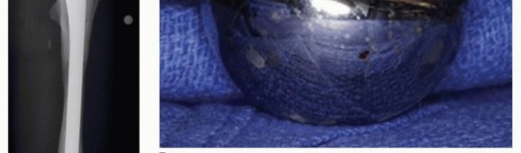 Illustration 31 for Allograft Prosthetic Composite: Mastering Proximal Femur Reconstruction