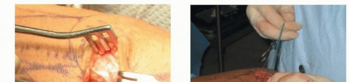 Illustration 18 for Chronic Patellar Instability: From Acute Onset to Lasting Solutions