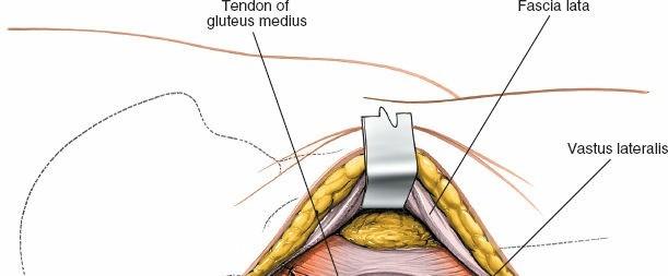 Illustration 133 for Unlocking Every Aspect of the Hip's Surgical Approaches