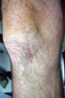 صورة طبية: جراحة استبدال مفصل الركبة الجزئي (UKA): تجنب الأخطاء والاستفادة القصوى في صنعاء مع الأستاذ الدكتور محمد هطيف