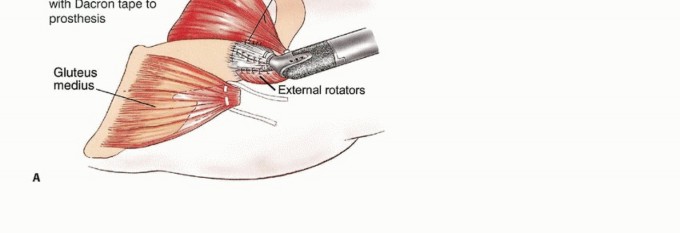 Illustration 47 for Beyond Amputation: Total Femur Resection with Endoprosthetics