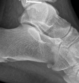 Illustration 10 for Partial Articular Fractureplate Fixation: Restore Anatomy