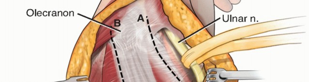 Illustration 41 for Surgical Approaches to Shoulder & Elbow: Pearls and Pitfalls