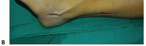 Illustration 51 for Restore Movement: Tendon Transfer for Common Peroneal Nerve Foot Drop