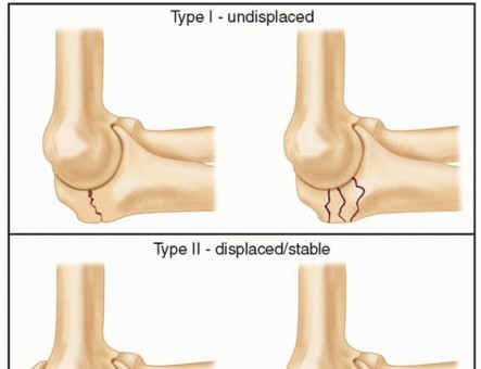 Fractures of the Proximal Ulna