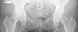 Primary Uncemented Total Hip Arthroplasty: A Case Study Title