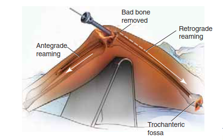 Illustration 11 for Knee Arthrodesis: A Lifelong Knee Solution for Trauma & TKA