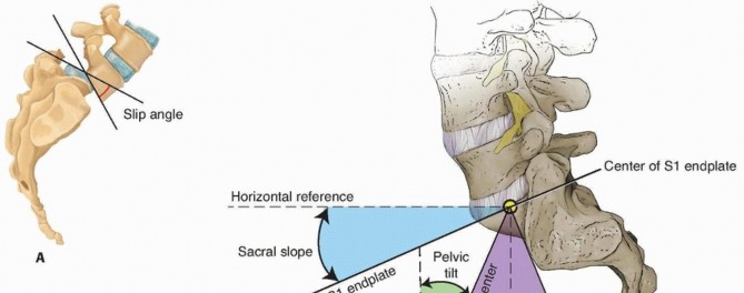 Illustration 9 for Mastering High-Grade Spondylolisthesis: Posterolateral and Interbody Fusion