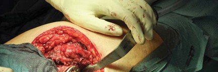 Illustration 67 for Collum Femoris Preserving: Achieve Better Primary Hip Outcomes