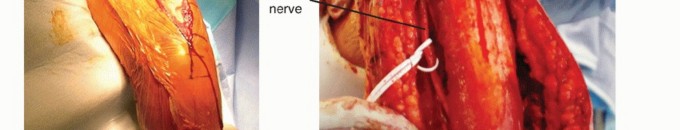 Illustration 14 for Surgical Approaches to Shoulder & Elbow: Pearls and Pitfalls