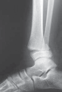 Illustration 15 for Pediatric Ankle Fractures: Management to Prevent Long-Term Issues