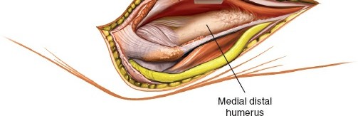Illustration 9 for Medial Approach to the Distal Humerus: Master Techniques & Avoid Osteotomy