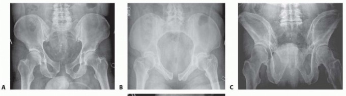 Illustration 9 for Achieve Stable Fixation of the Symphysis: Open Reduction