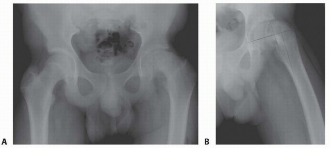 Flexion Intertrochanteric Osteotomy: Realigning Severe SCFE Hips