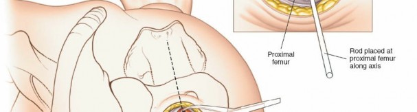 Illustration 75 for Optimal Femoral Approaches: Mastering the Lateral Intermuscular Septum
