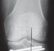 Illustration 49 for Guide Pin Assembly: Key to Flawless Upper Tibial Osteotomy
