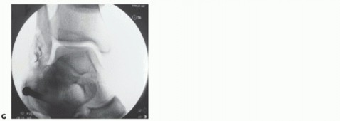 Illustration 14 for Lateral Ankle Repair: Maximize Stability with Interference Screw Fixation