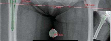 Illustration 20 for Maximize Success: Preoperative planning in primary Hip Replacement