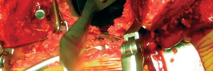 Illustration 53 for Cemented Component Longevity: The Critical Margin of the Acetabulum