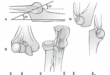 Elbow Dislocation: Understanding Your Injury for a Healthy Elbow