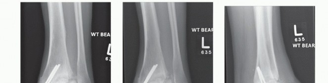 Illustration 27 for Optimize Pain Management with Proximal Ring Block for Ankle Arthrodesis