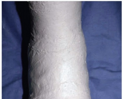 Illustration 14 for Restore Your Foot: Surgical Treatment for Hallux MP Joint Turf Toe