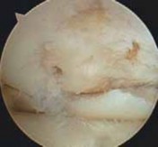 Illustration 18 for Guide Pin Assembly: Key to Flawless Upper Tibial Osteotomy