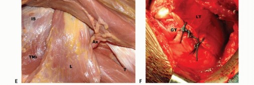 Illustration 24 for Restore Shoulder Function with Latissimus Dorsi Tendon Transfer