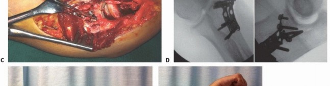 Illustration 6 for Restore Stability & Motion: Fixation of Fracture-Dislocations