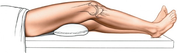 Illustration 50 for Optimal Femoral Approaches: Mastering the Lateral Intermuscular Septum